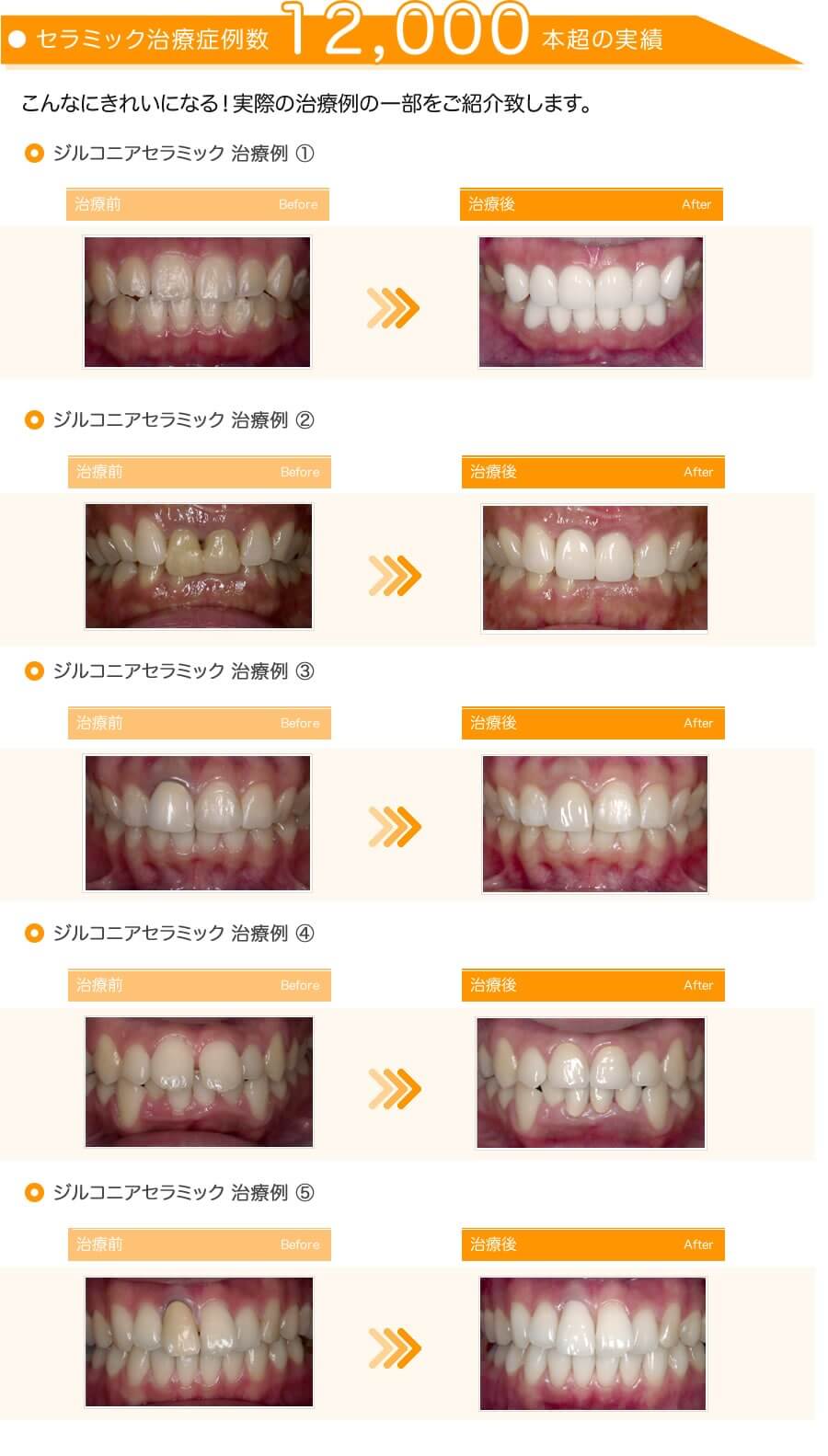 差し歯：前歯の症例